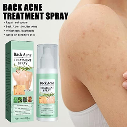 Back Acne Treatment Spray (Pack of 1)