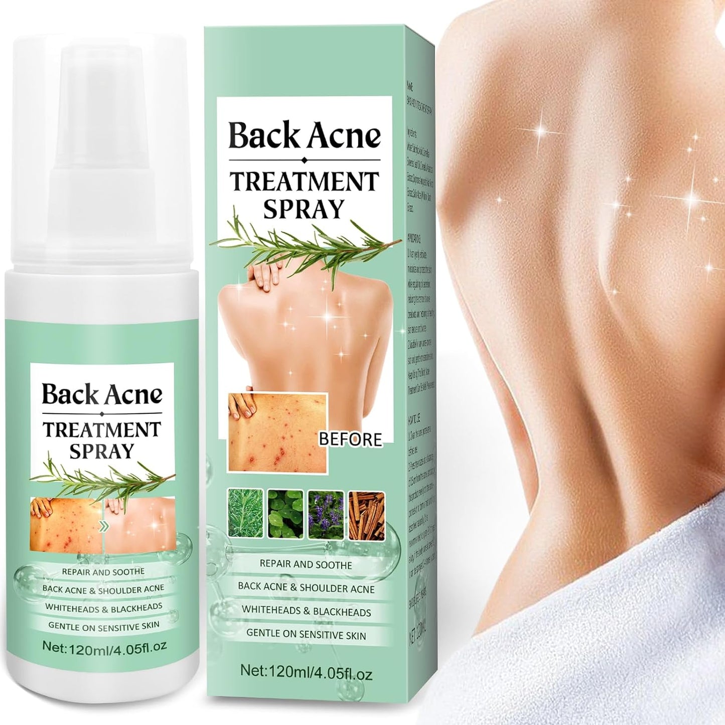 Back Acne Treatment Spray (Pack of 1)